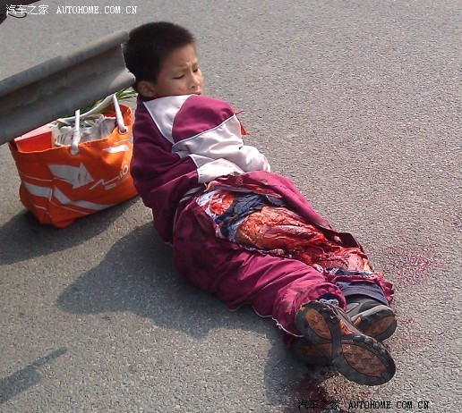 宁波联丰菜场门口斑马线货车不减速把小学生一只大腿撞成血肉模糊