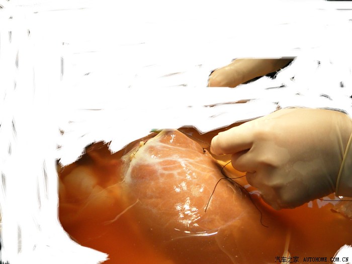 【图】哥是个移植外科医生,年收入不到100万,