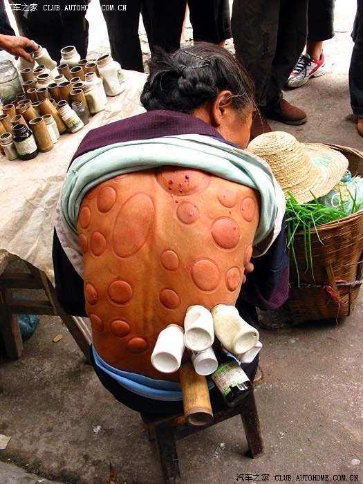 民间老伯街头拔火罐 震撼到我了