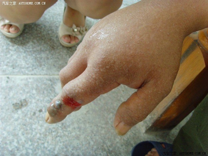 浸蛇酒被五步蛇咬了好毒啊!