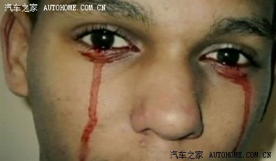 13岁女孩流泪出汗竟是血